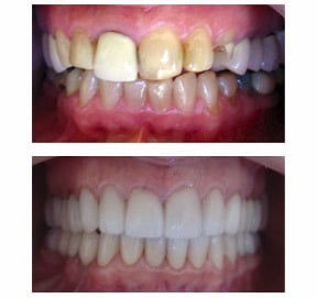 Full Mouth Reconstruction - Before & After Katy, TX