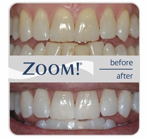 Teeth Whitening Katy, TX