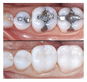 Porcelain Inlays & Onlays Katy, TX