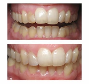 Before and After Image of Tooth Shaping Before and After Image of Tooth Shaping Katy, TX