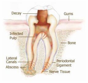 Root Canal Treatment