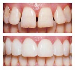uw9o4yi3 porcelain veneers - before & after Katy, TX