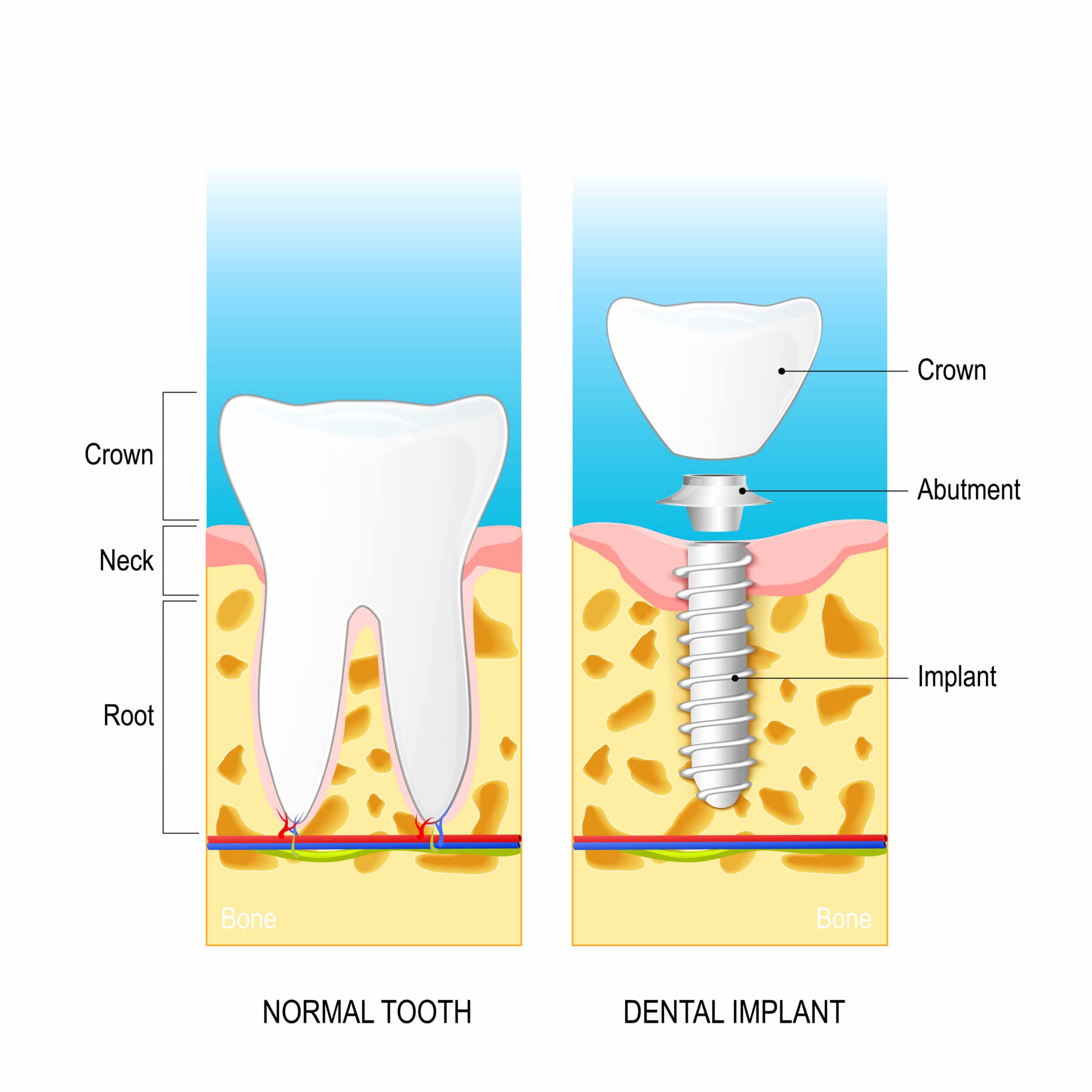 Normal Human tooth and Structure of Dental Implant