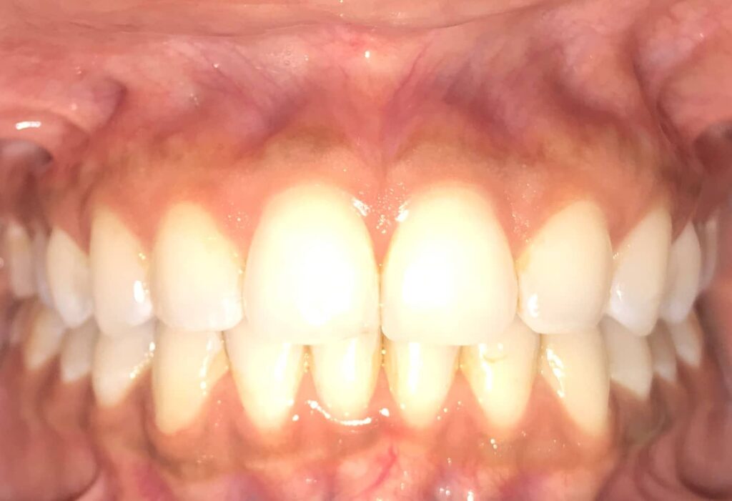 ip final invisalign ip final invisalign