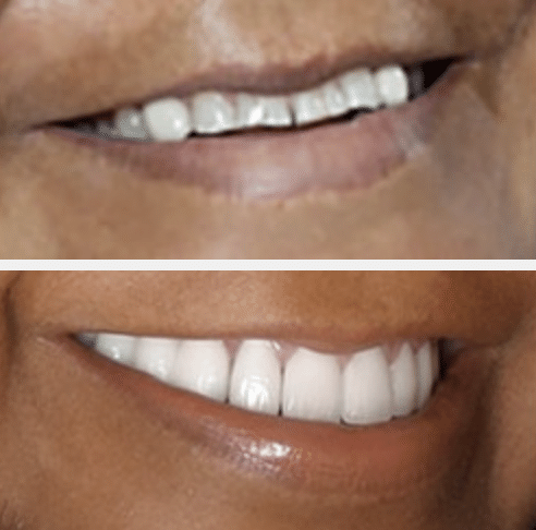 porcelain veneers before and after photos Katy, TX