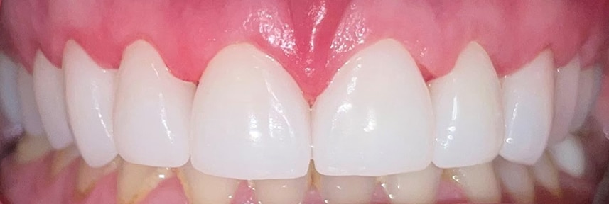 After Image: Full Upper Combination of Crowns and Veneers - front