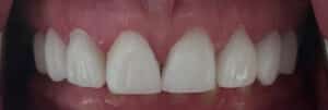 Full Upper Combination of Crowns and Veneers