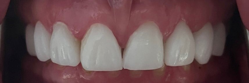 Before Image: Full Upper Combination of Crowns and Veneers - front