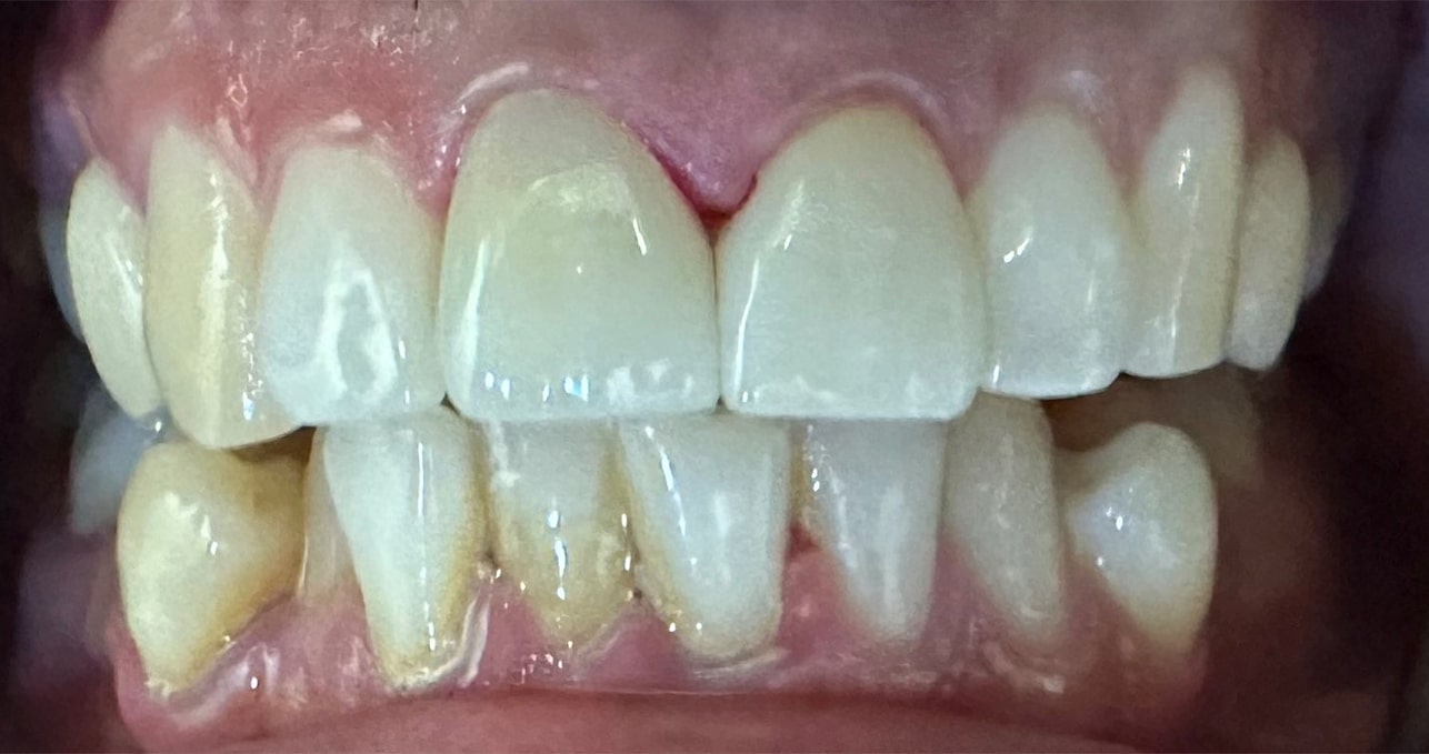 After Image: 2 Front Crowns - front