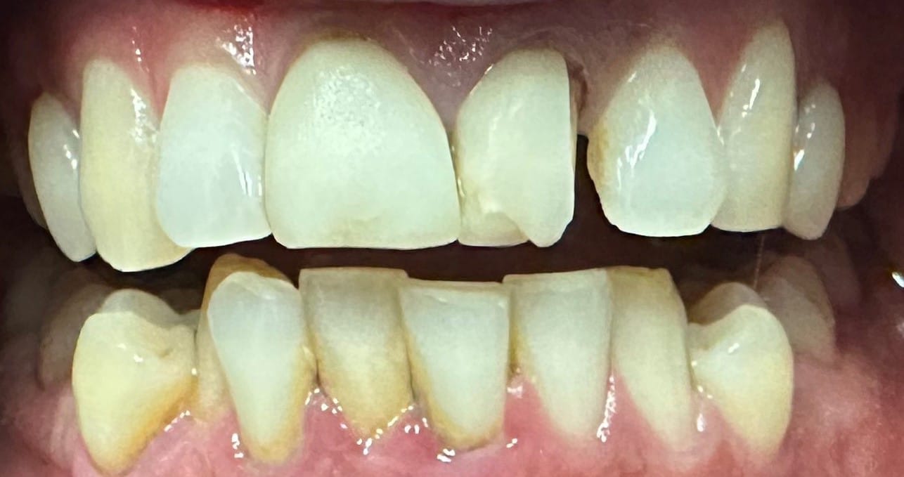 Before Image: 2 Front Crowns - front