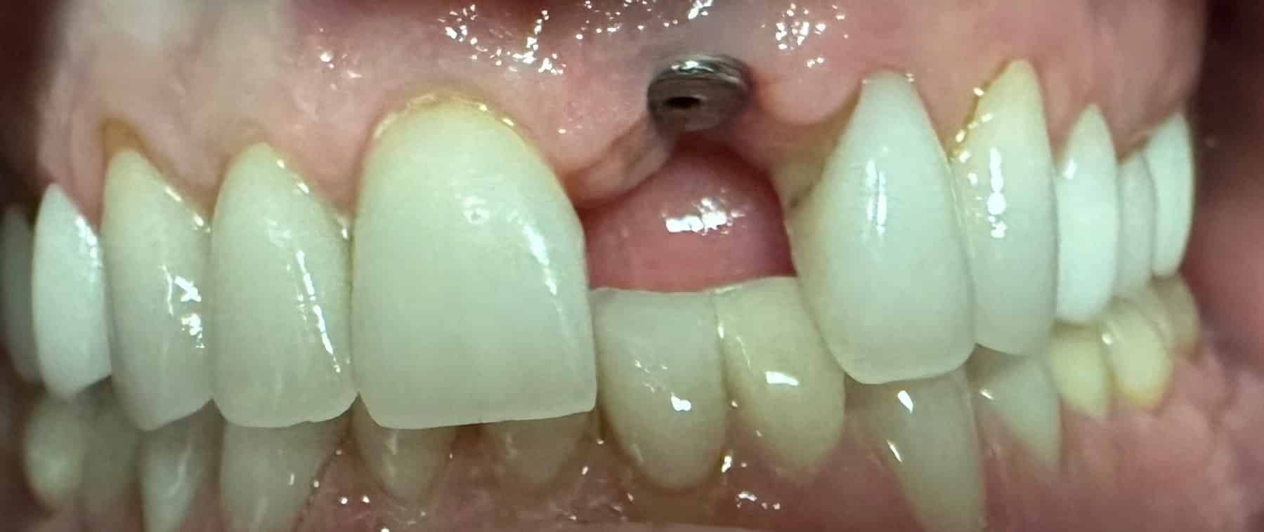 Before Image: Implant - front
