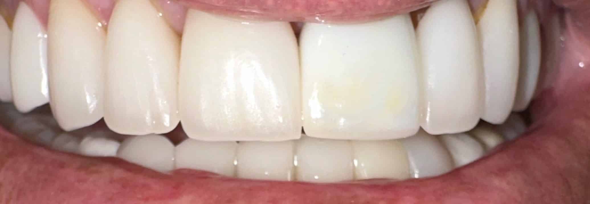 After Image: Implant - front