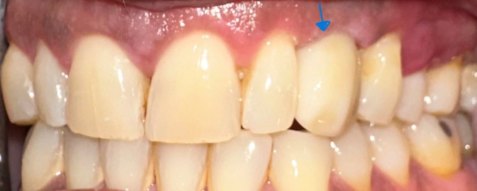 After Image: Implant - front