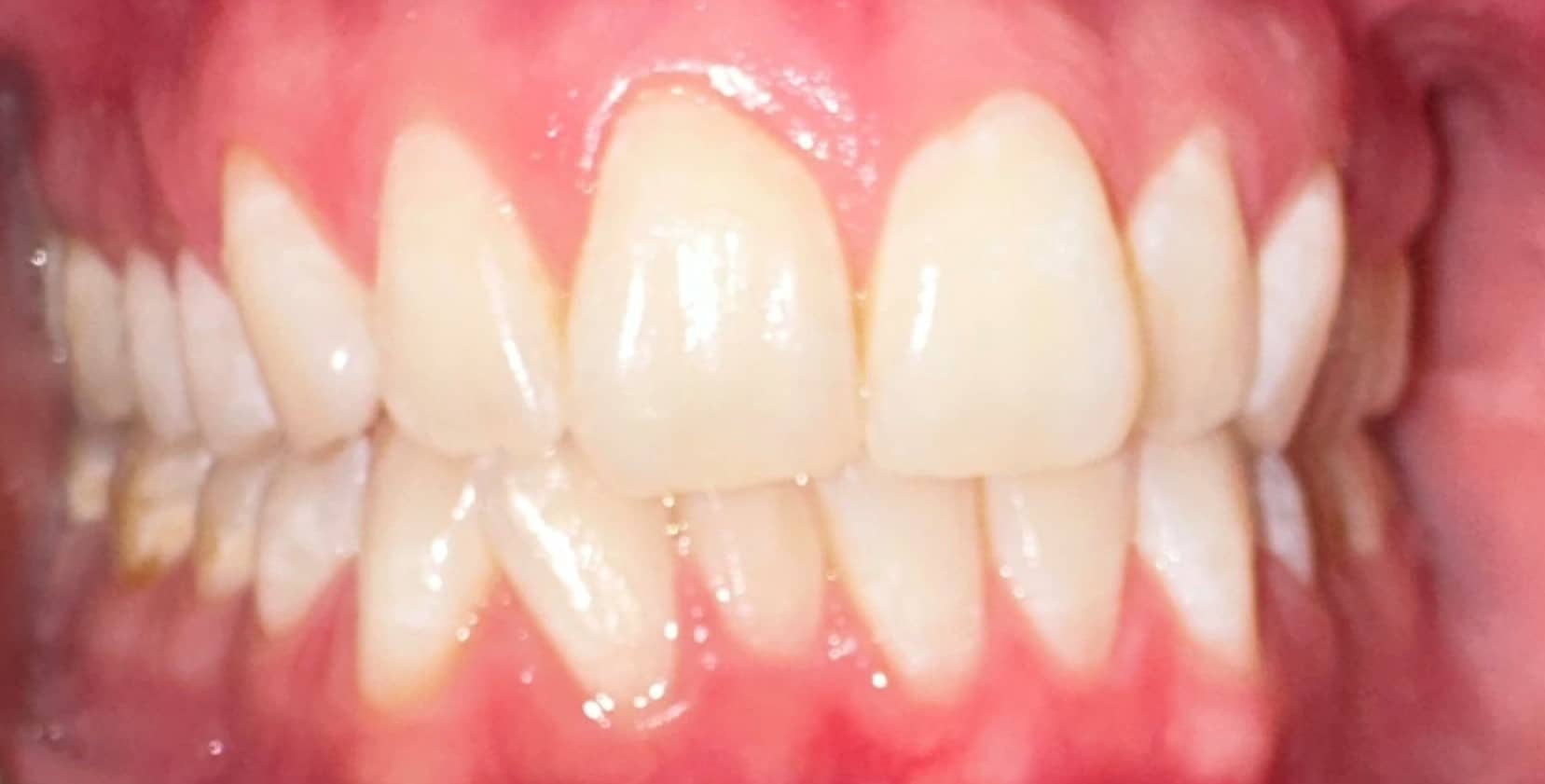 Before Image: Invisalign