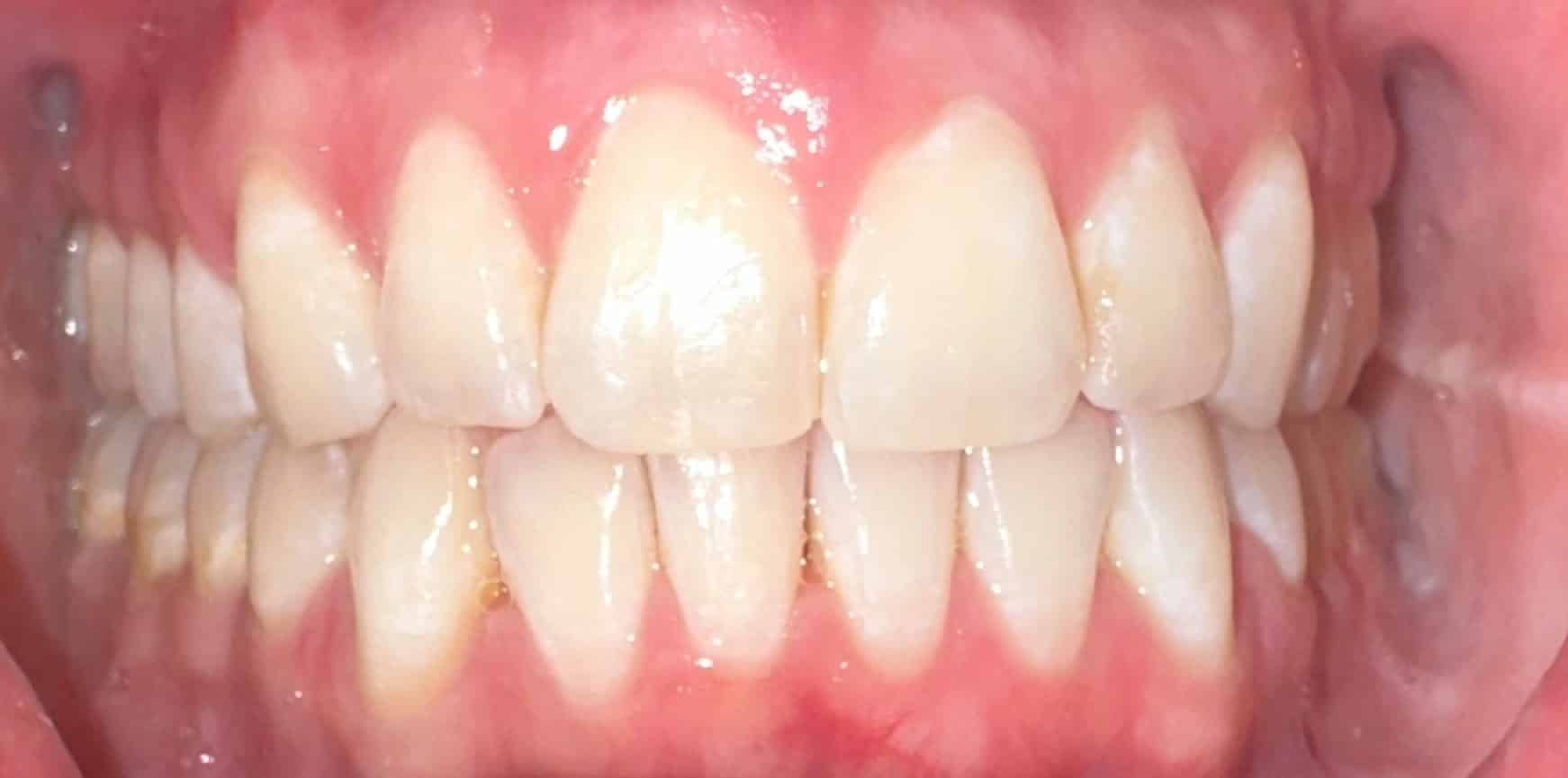 After Image: Invisalign