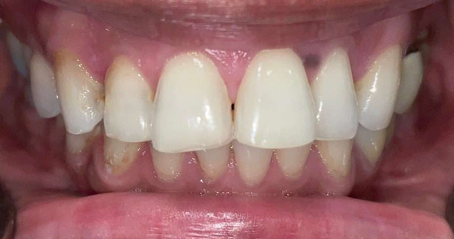 Before Image: Full Mouth Reconstruction - front