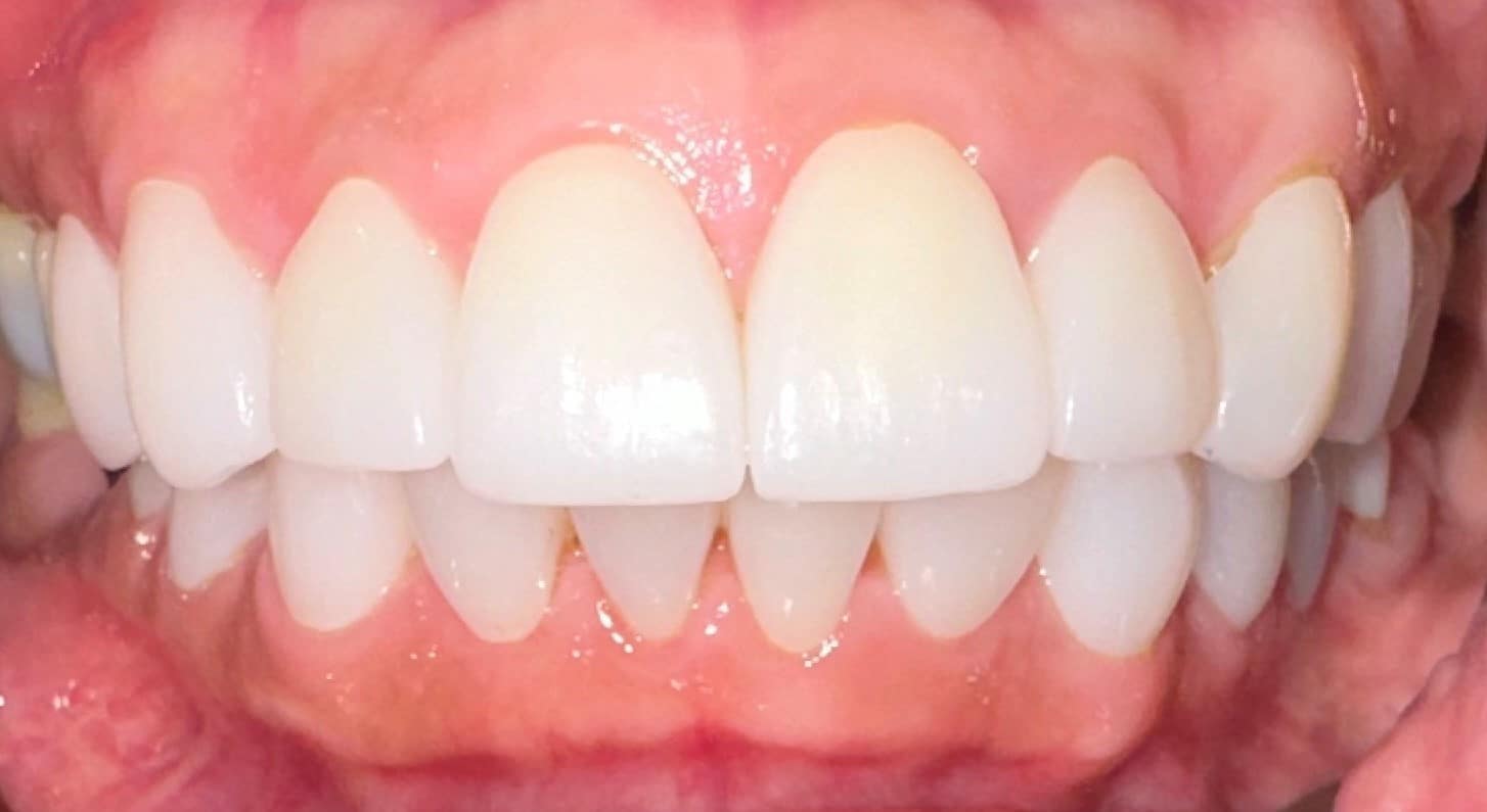 After Image: Full Mouth Reconstruction - front