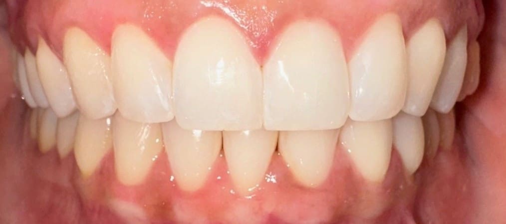 After Image: Invisalign