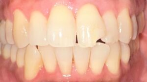 Before Image: Front Veneer