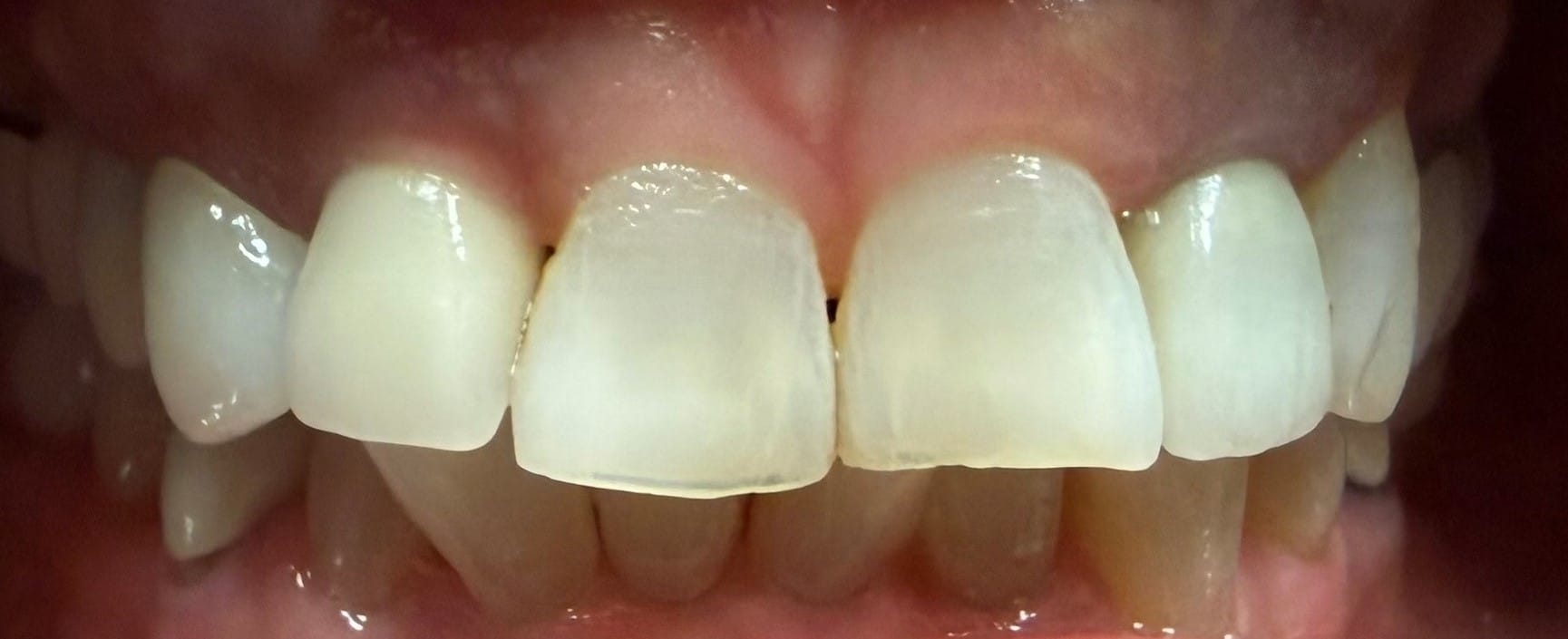 Before Image: 6 Upper implant/Veneer/Crown combo