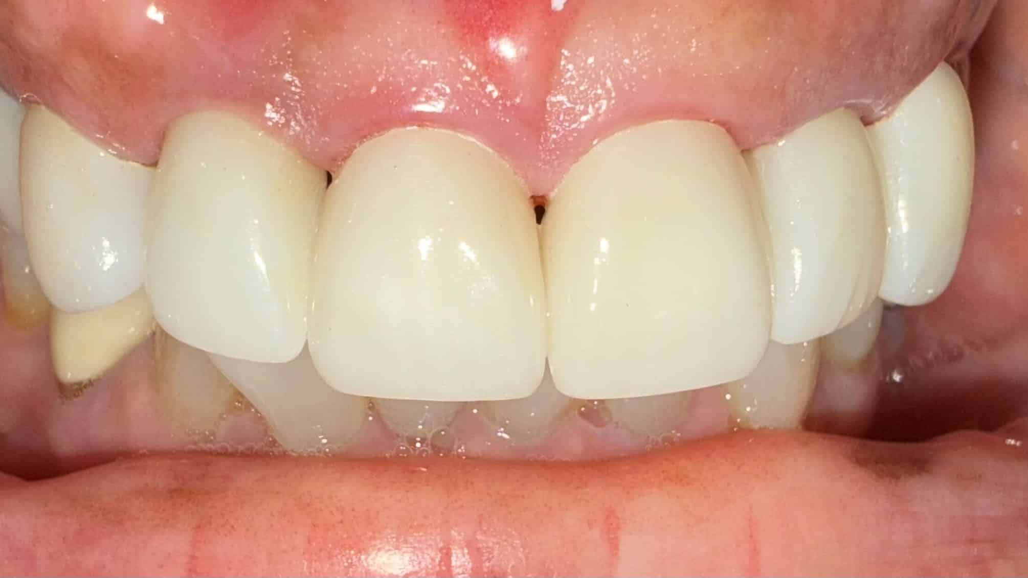 After Image: 6 Upper implant/Veneer/Crown combo