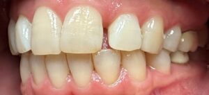 Before Image: Invisalign