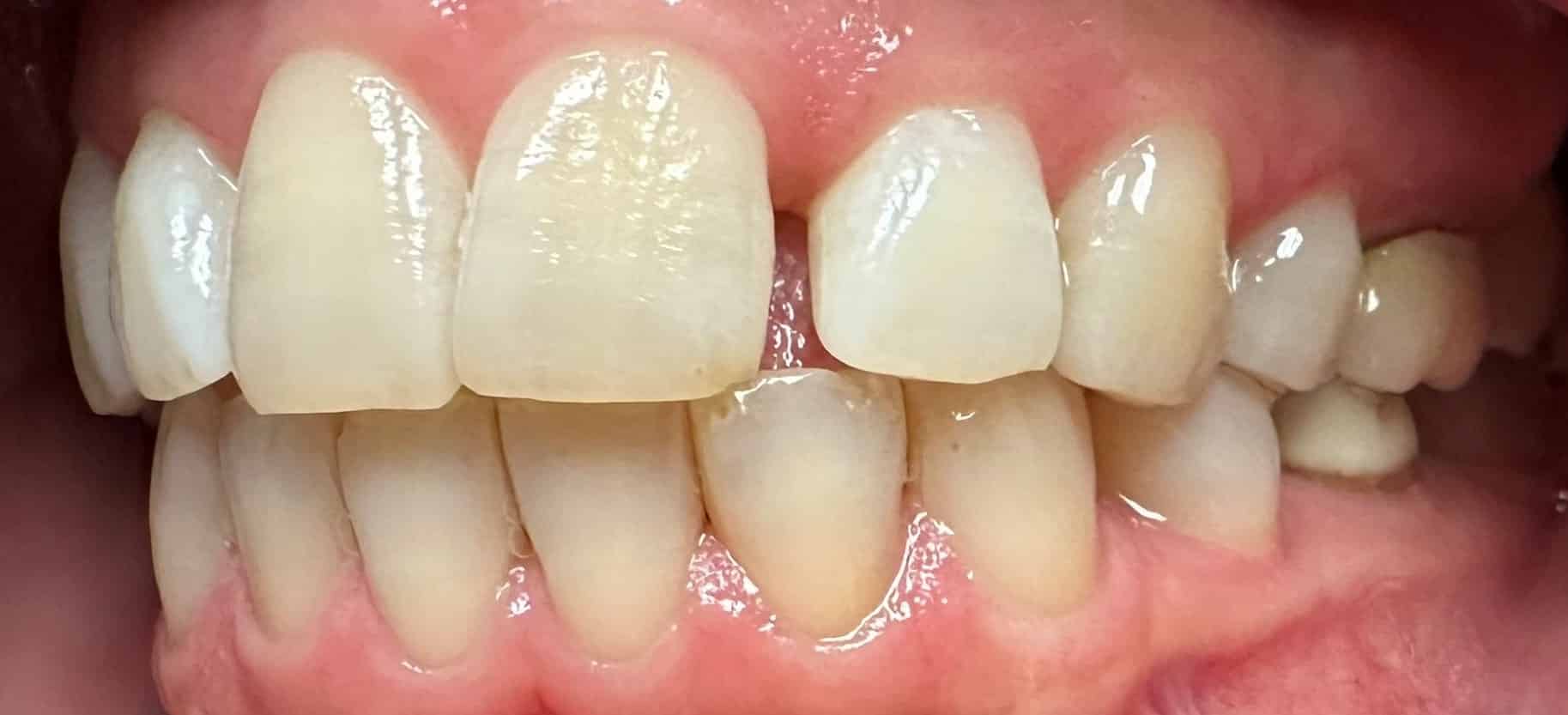 Before Image: Invisalign