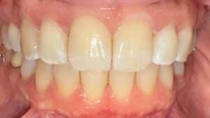 After Image: Invisalign