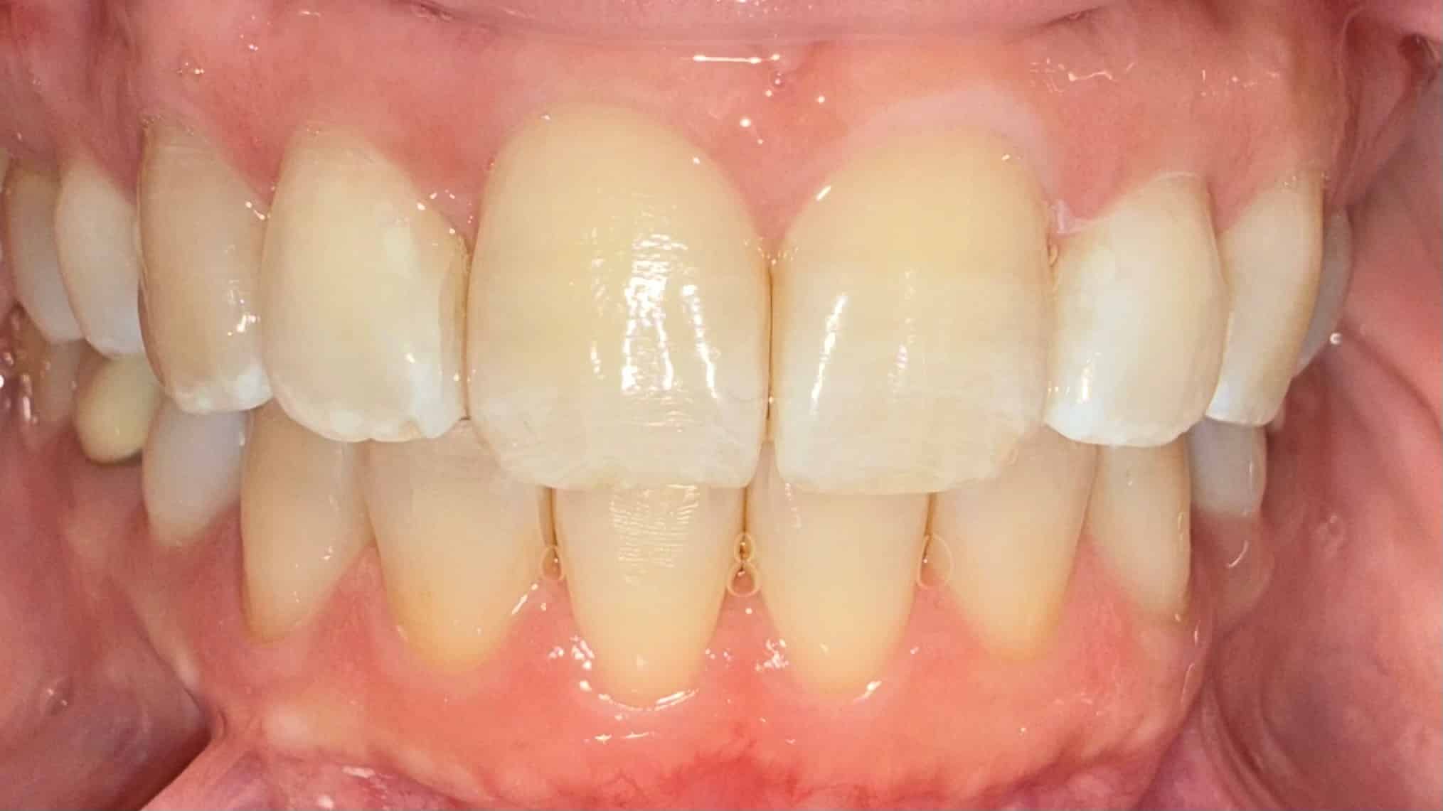 After Image: Invisalign
