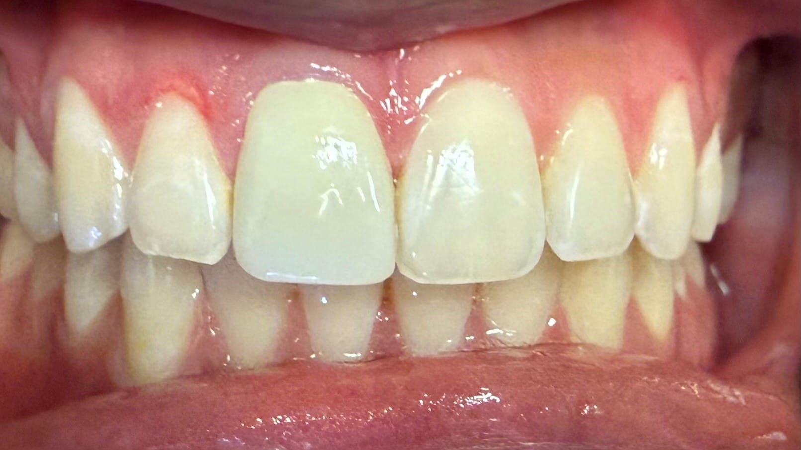 After Image: Single Crown - front