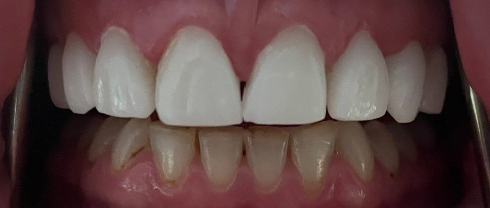 Before Image: Full Mouth reconstruction with veneers, crowns and an implant
