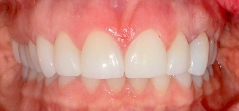 After Image: Full Mouth reconstruction with veneers, crowns and an implant - front
