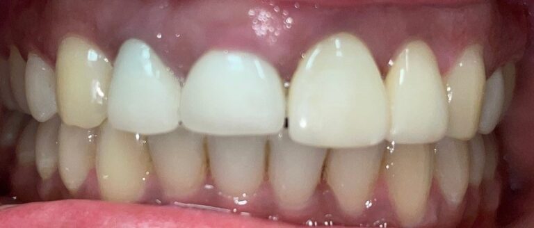 Before Image: 1 Veneer and gum recontouring - front