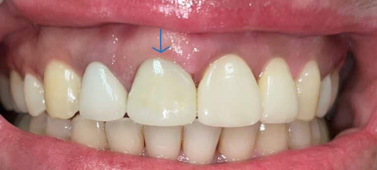 After Image: 1 Veneer and gum recontouring - front