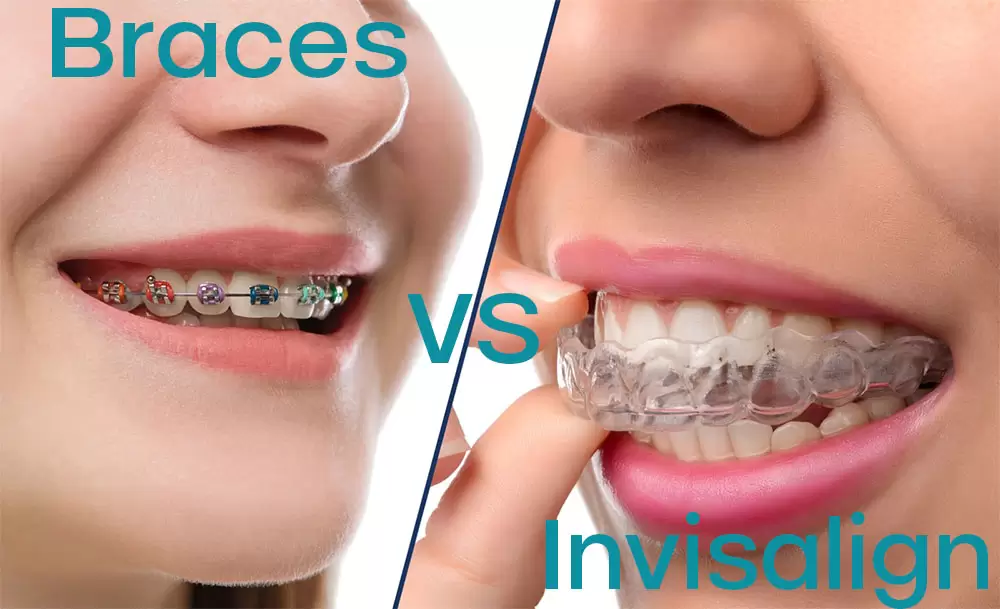 braces-vs-invisalign Braces vs Invisalign Cinco Ranch TX