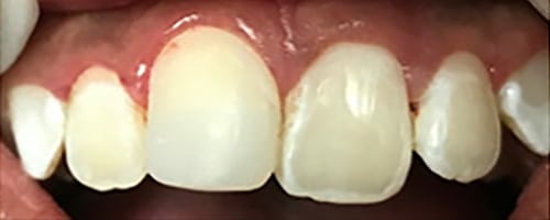 After Image: Root Canal + Composite bonding - front