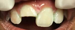 Before Image: Root Canal + Composite bonding