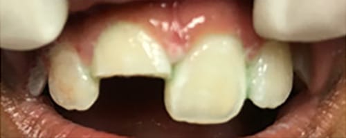Before Image: Root Canal + Composite bonding - front