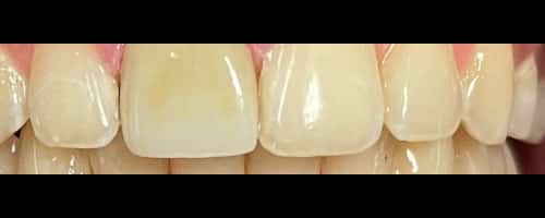 After Image: Root Canal + Composite bonding - front