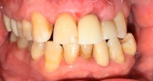 After Image: Single Unit Implant