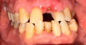 Before Image: Single Unit Implant
