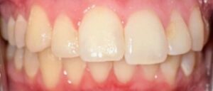 Before Image: Invisalign