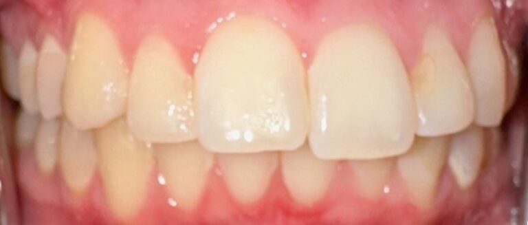 Before Image: Invisalign - front