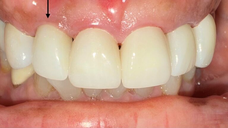 After Image: Single unit Implant - front