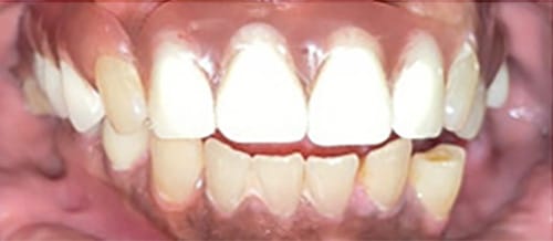 After Image: Upper Partial Denture - front