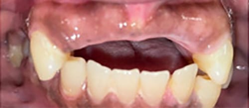 Before Image: Upper Partial Denture - front