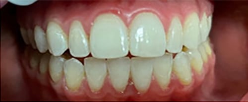 After Image: Zoom Whitening - front