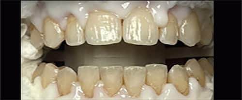 Before Image: Zoom Whitening - front