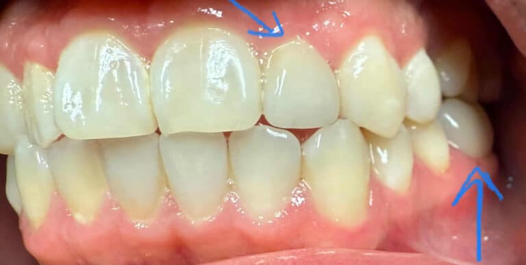 After Image: Crowns, Composites and Zoom Whitening - front
