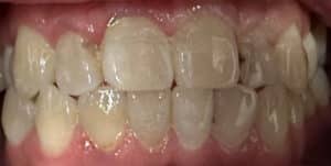 Before Image: Crowns, Composites and Zoom Whitening